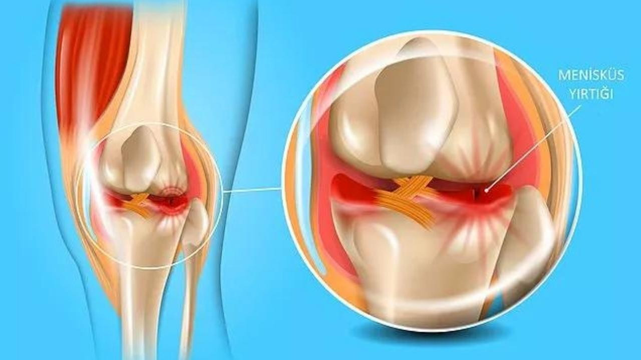 Повреждение мениска