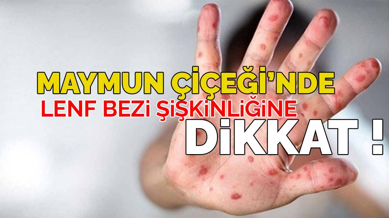 Maymun Çiçeği Virüsünde Lenf Bezi Şişliğine Dikkat!