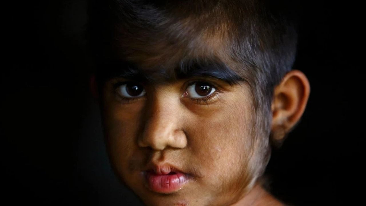 Saç Spreylerine Dikkat: İspanya'da 11 Bebekte Görüldü! - Sayfa 2