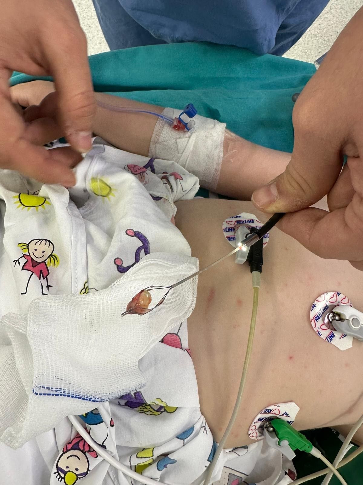 2 Yaşındaki Bebeğin Öksürük Nöbetine, Akciğerine Kaçan Fındık Sebep Olmuş - Sayfa 2