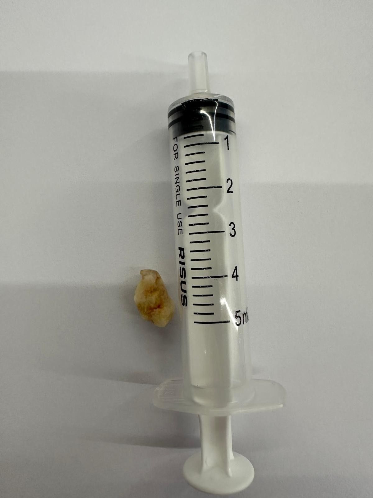 2 Yaşındaki Bebeğin Öksürük Nöbetine, Akciğerine Kaçan Fındık Sebep Olmuş - Sayfa 3