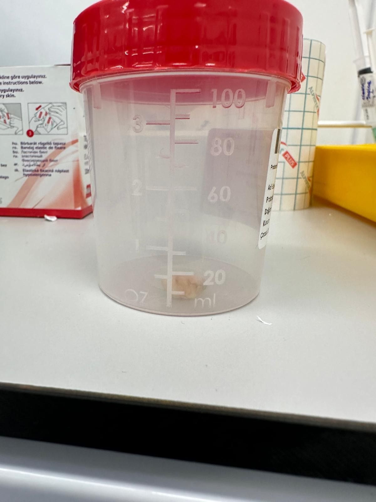 2 Yaşındaki Bebeğin Öksürük Nöbetine, Akciğerine Kaçan Fındık Sebep Olmuş - Sayfa 4