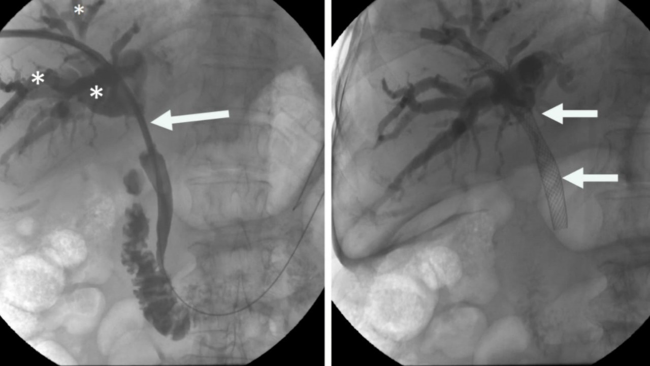 Hibrit Yaklaşımla, Zorlu Safra Yolu Tedavilerinde Yeni Dönem