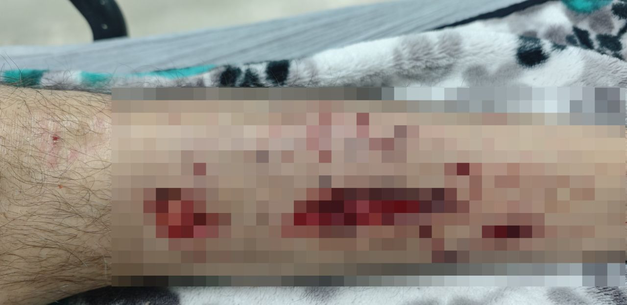 Diyarbakır’da Alzheimer Hastası Adam Köpeklerin Saldırısına Uğradı - Sayfa 1