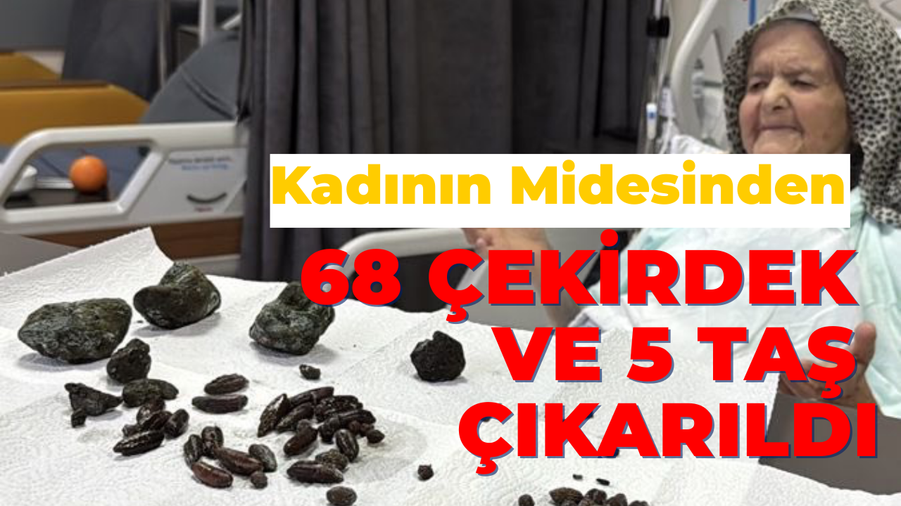 92 Yaşındaki Kadının Midesinden 68 Çekirdek ve 5 Taş Çıkarıldı