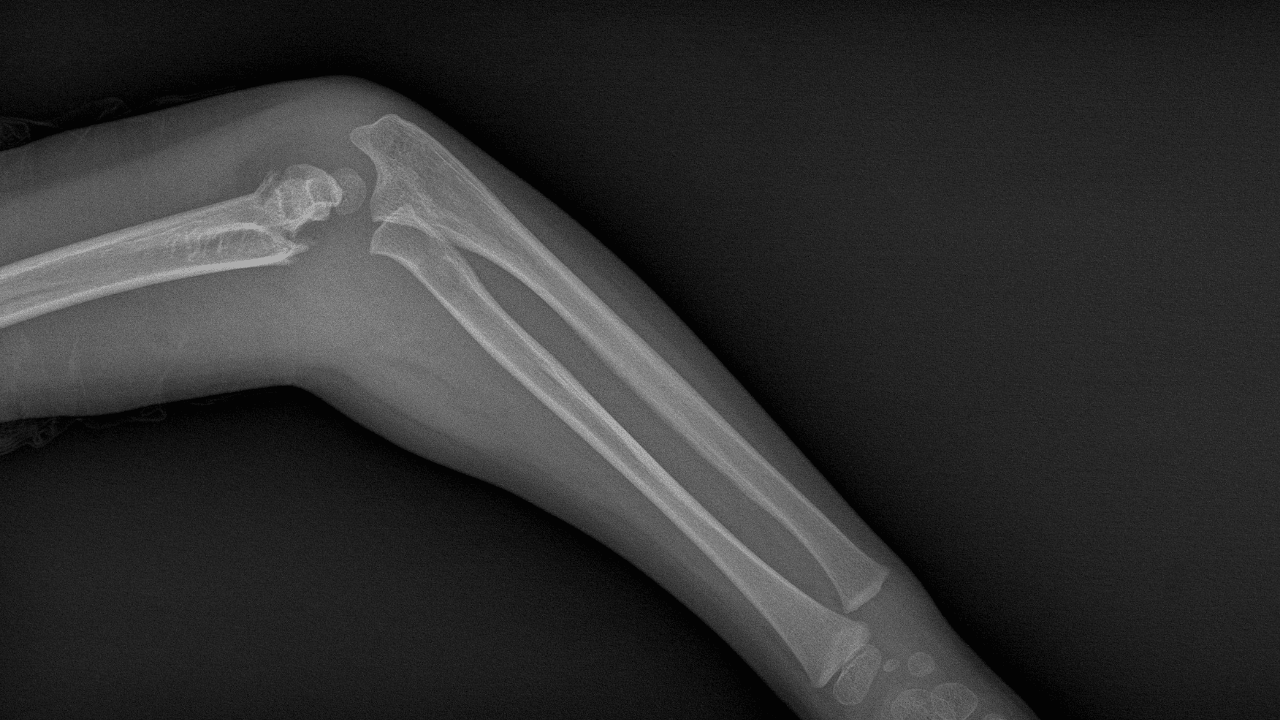 3 Dakikada Yapıştıran Kemik Yapıştırıcısı Geliştirdi - Sayfa 4