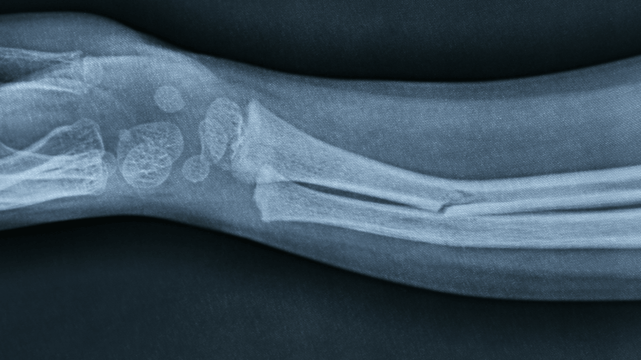 3 Dakikada Yapıştıran Kemik Yapıştırıcısı Geliştirdi - Sayfa 1