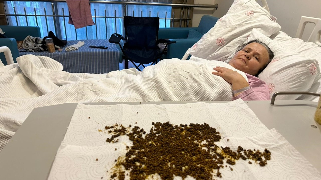 Safra Kesesinden 20 Binin Üzerinde Taş Çıkarıldı