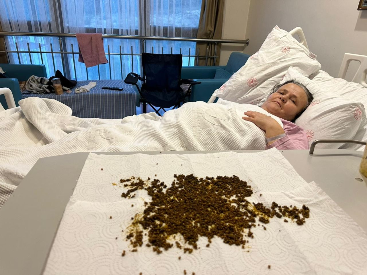 Safra Kesesinden 20 Binin Üzerinde Taş Çıkarıldı - Sayfa 1