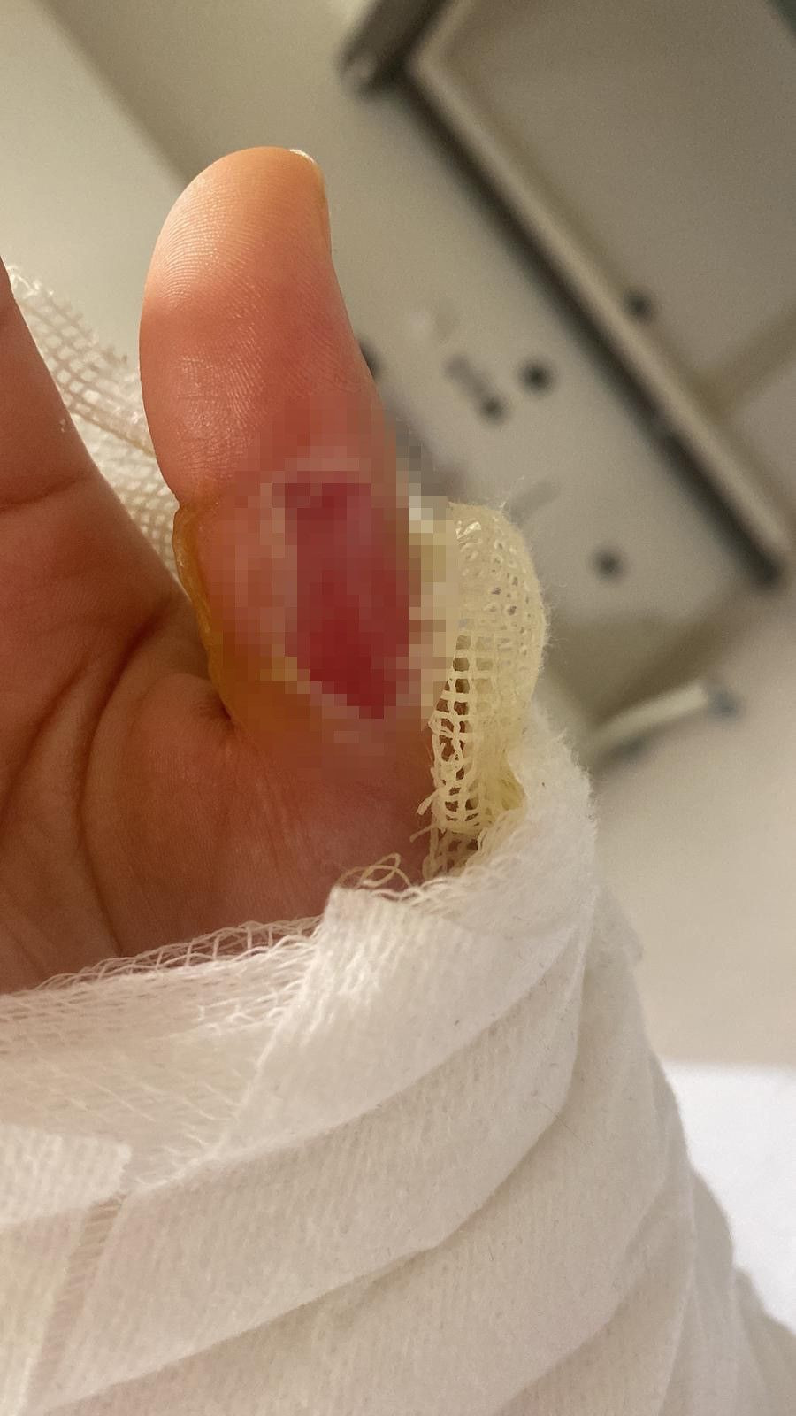 Sıcak su torbası faciası: Genç kızın vücudunun yüzde 25’i yandı - Sayfa 4