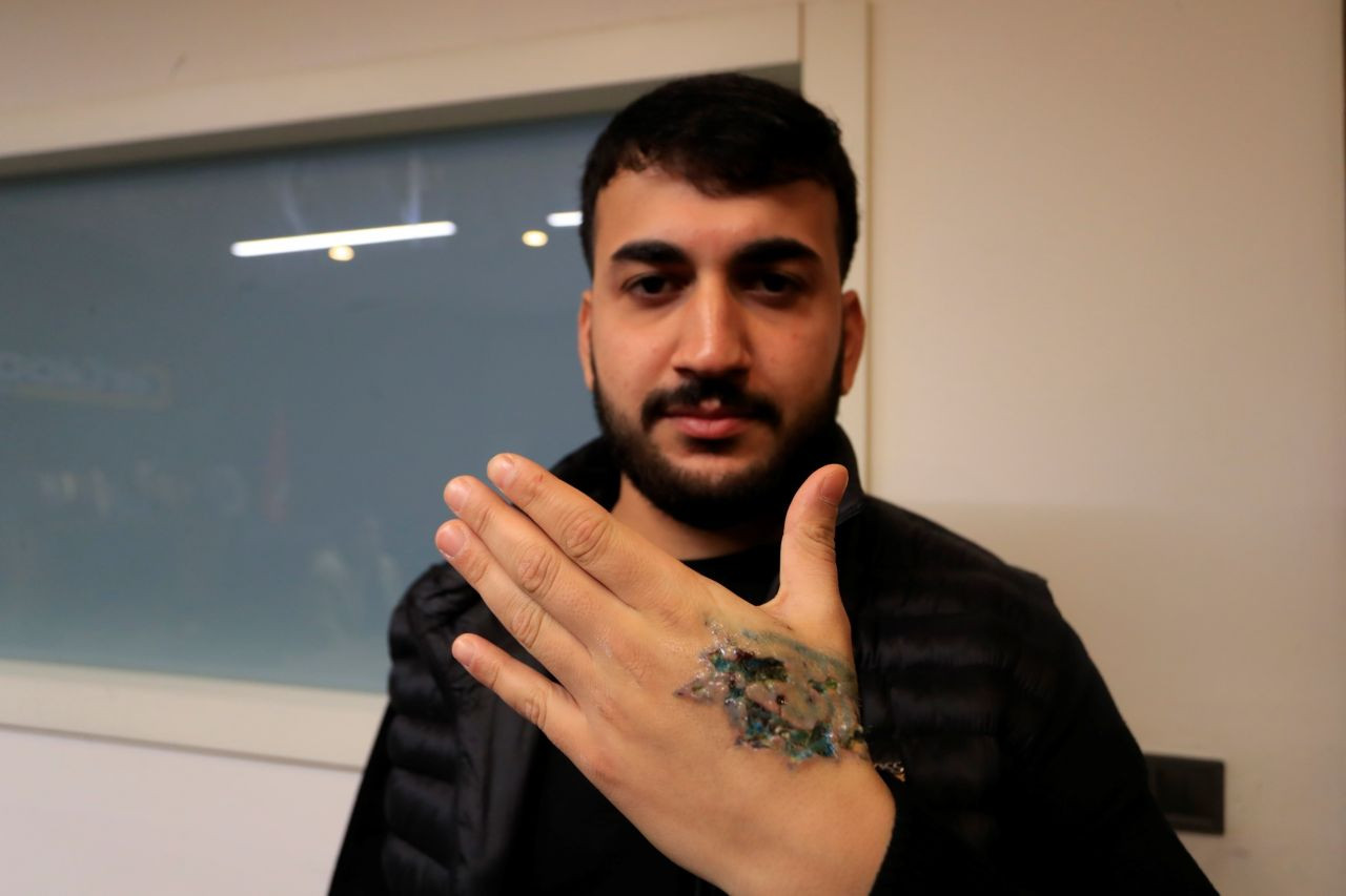 Dövme Sildirme İşlemi Kabusa Döndü - Sayfa 4