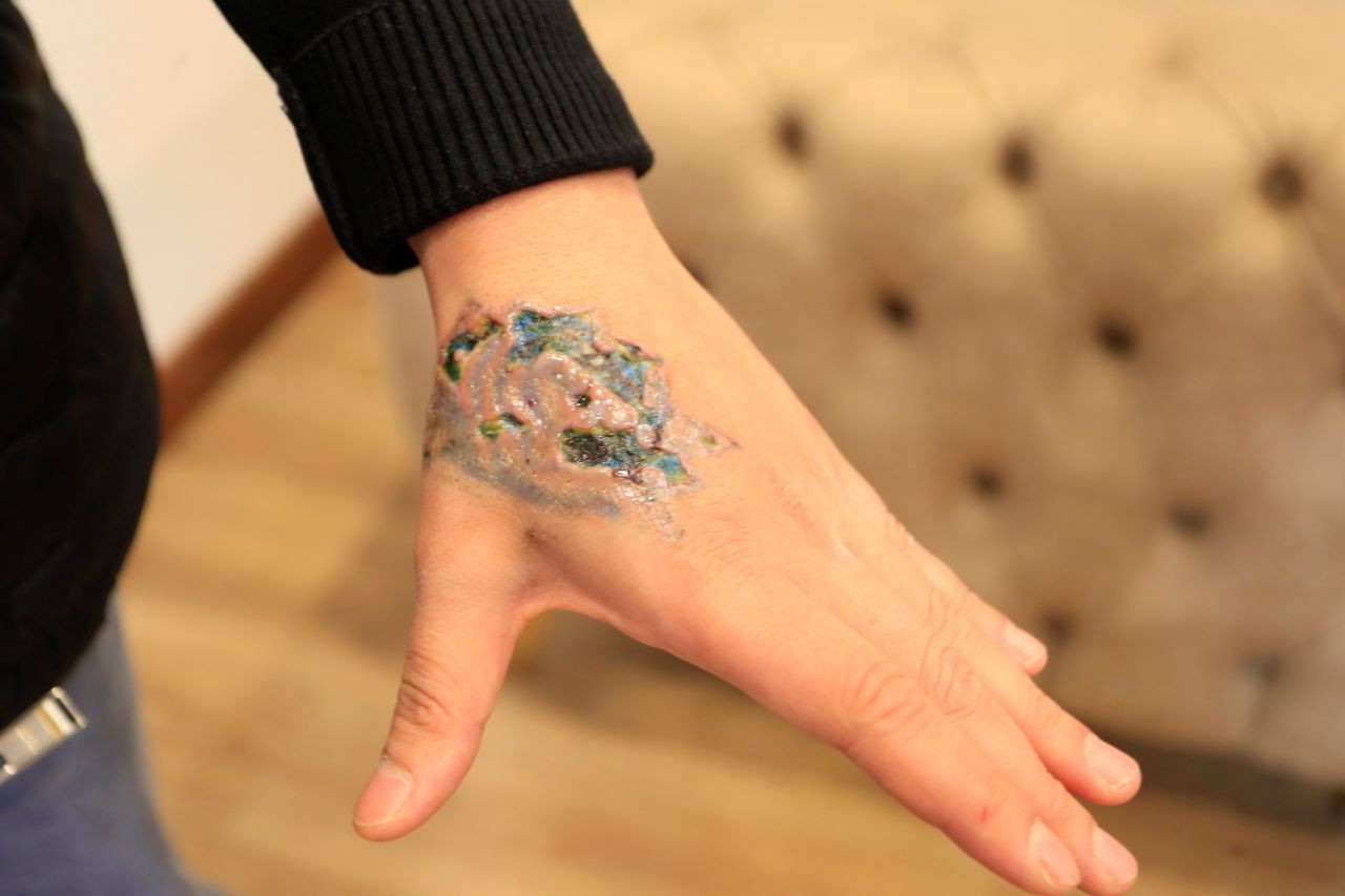 Dövme Sildirme İşlemi Kabusa Döndü - Sayfa 2